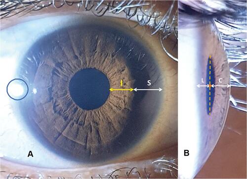 Figure 1 Photogrammetry of images on anterior and temporal perspectives. (A) Estimation of nasal iris illumination on anterior perspective (image acquired using flashlight method). Corneal reflex at temporal limbus surrounded by blue circle. I, distance between nasal pupillary border and start of iris shadow; S, distance between start of iris shadow and nasal limbus. (B) Relative position of midpoint of pupil to corneal apex and temporal limbus (image acquired using the temporal perpendicular method). C, distance of midpoint of pupil from corneal apex; L, distance of midpoint of pupil from temporal limbus. Midpoint of pupil determined as midpoint of vertical line joining superior and inferior pupillary edges.