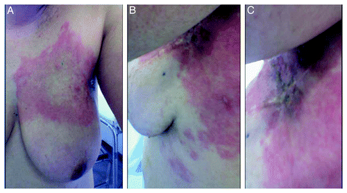 Figure 1. Left breast erythema and skin nodules located in continuity with the surgical scar.