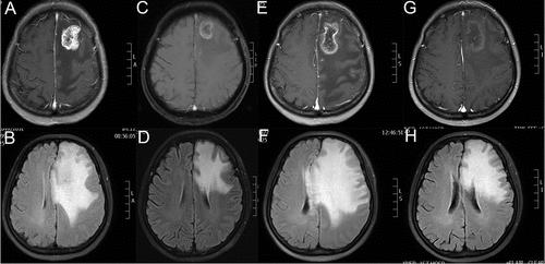 Figure 2. Brain MRIs of the patient revealed the size of BM lesion and PTBE. (A,C,E,G) The BM maximum diameter slice of T1-weighted MRI with contrast in 03/2017, 11/2017, 02/2018 and 03/2018 respectively. (B,D,F,H) The most obvious slice of PTBE in Flair-weighted MRI in 03/2017, 11/2017, 02/2018 and 03/2018 respectively. As Figure 1F shows, extensive PTBE caused progressive neurological deficits of the patient in 02/2018 which failed to be improved by high dose of steroids and dehydrants. As Figure 1H demonstrates, the PTBE shrank dramatically after use of apatinib 35 days.