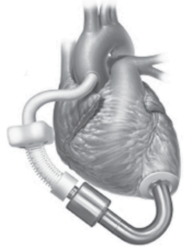 Figure 12 MicroMed Debakey CHILD LVAD, courtesy of www.micromedcv.com.