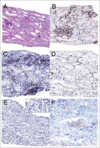 Figure 1. The renal biopsy showed interstitial inflammatory infiltrates with focal tubulitis (A; PAS original magnification × 20). Immunohistochemical stainings revealed a predominant T cell infiltrate (B; CD3, 20x), consisting of both T-helper cells (C; CD4, 20x) and cytotoxic T cells (D; CD8, 20x). There were scattered PD1 positive cells (E; PD1, 20x, the enlarged insert 40x) and some tubular cells expressing PD-L1 (F; PD-L1 80X).