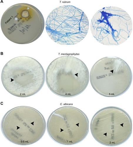 Figure 3 Patients’ fungal culture test.