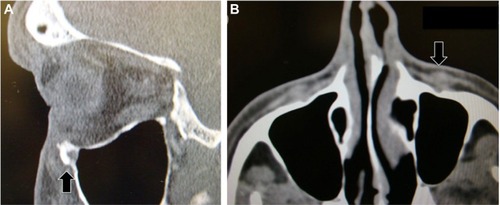 Figure 2 (A) Sagittal and (B) axial CT images demonstrating a mass in the left inferior orbit, with suggestive orbital rim bone erosion (black arrows).