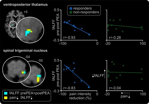 Figure 4 Relationships between changes in pain intensity and infra-slow oscillations as a result of palmitoylethanolamide (PEA) treatment. Significant positive linear relationships between changes in ongoing pain and fractional amplitude of low-frequency fluctuations (fALFF) in the thalamus and medulla are shown overlaid onto axial T1-weighted anatomical slices for the responder group only (yellow shading). Note no such relationship occurred in the non-responders. Slice locations in Montreal Neurological Institute space are indicated at the top right of each slice. The location of significant decreases in infra-slow oscillations (ISO) pre- versus post-PEA are also shown (light blue shading); note the overlap within the spinal trigeminal nucleus and ventroposterior thalamus. To the right are plots of change in fALFF versus percent change in pain for the SpV and VP thalamus cluster in responders and non-responders pre- versus post-PEA treatment. In responders, the greater the reduction in fALFF the greater the reduction in pain intensity.