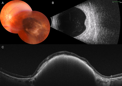 Figure 4 Multimodal imaging in dormant choroidal melanoma. (A) Composite color fundus photograph shows choroidal melanoma located inferotemporal to the fovea. (B) B-mode ultrasonogram demonstrates the acoustically solid lesion with no posterior shadowing. (C) Swept source optical coherence tomography shows retinal thinning, loss of retinal lamination, subretinal hyperreflective deposits, and hyperreflective anterior wall of the mass with choroidal compression.