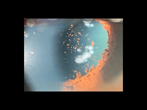 Figure 4 Postoperative images of acute burns of the iris and anterior lens cortex, associated with IDO laser treatment using normal settings of 300 mw power, 0.1 sec, but with inadequate dilation of a brown iris. Courtesy of Retina Specialists of Alabama, LLC.