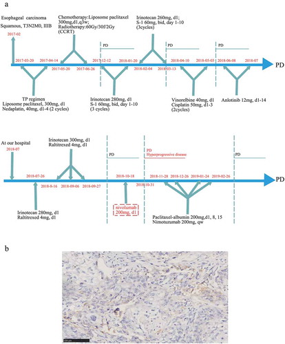 Figure 1. Clinical and histological data of the patient from our center. (a) The timeline of treatments for a patient with advanced esophageal squamous carcinoma. (b) The PD-L1 expression in tissue sample by IHC using 22C3 (X200)
