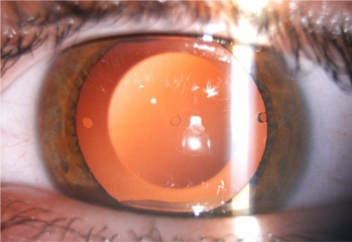 Figure 1 Example of a lens implanted in one of the patients.