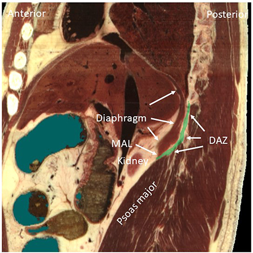 Figure 3 The sagittal schematic diagram shows the positions of the MAL and DAZ. The MAL is the inferior edge of diaphragm, which is curved over the psoas major muscle. The green-colored area indicates the DAZ.