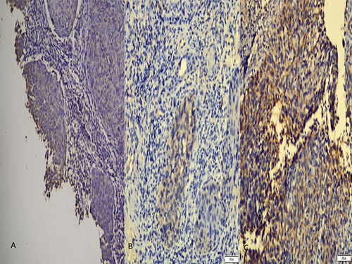 Figure 1 Results of staining of N-cadherin on NPC tissue by immunohistochemical technique at 200x magnification. There are 3 pictures attached as figure 1 which represents staining results with immunohistochemical technique. (A). Visible light yellow intensity outward appearance on the cytoplasm and cell membranes. Shows weak expression of N-cadherin (B). It looks yellow intensity on the cytoplasm and cell membranes. Shows a weak expression of N-cadherin (C). The intensity of the brown color appears on the cytoplasm and cell membranes. Shows strong N-cadherin expression.