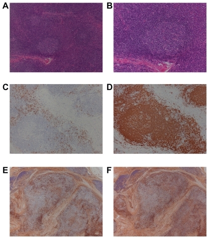 Figure 2 Histopathological findings in a specimen of the right lacrimal gland. H&E staining at low magnification (A × 100) and high magnification (B × 200) showing infiltration of plasma cells surrounding the mantle zones and a pattern of concentric deposits with lymphoid cells. These are pathognomic of Castleman disease. The infiltrated cells surrounding the mantle zones were CD138 (C × 100), Igkappa (E × 100), Iglambda (F × 100), and CD79a positive (D × 100). However, compared to plasma cell type of Castleman disease, fibrosis in the interstitial tissue was relatively greater. Compared to hyaline-vascular type of Castleman disease, vascularization in the intrafollicular area was relatively poor. The development of mantle zones and the pattern of concentric deposits with infiltrating cells are not of typical of Castleman disease. We finally decided these tissues resemble reactive lesions rather than Castleman disease.