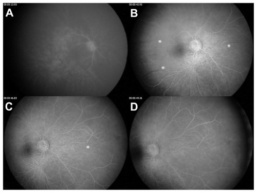 Figure 3 Arteriovenous transit phase fluorescein angiography of right eye. (A) Arterial filling at 19 seconds. (B and C) Mid-venous phase at 42 and 46 seconds (asterisks identify areas of delayed venous filling). (D) Venous filling not complete until 49 seconds.