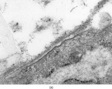 Figure 5 Portion of a myofibroblast showing intermediate filaments, actin filaments (arrowheads), dilated rough endoplasmic reticulum cisternae (rER), collagen inclusions (large and short arrows), and fibronexus (thin and long arrow), × 9,000. Insert: Detail of fibronexus junction showing a distinct fibrillary structure, × 56,000.