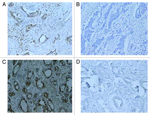 Figure 3. Immunohistochemistry analysis of Nkx2–3 and TGFB1I1. (A) Nkx2–3 high expression in cancer tissues in experimental group (200 size); (B) Nkx2–3 no expression in cancer tissues in control group (200 size); (C) TGFB1I1 high expression in cancer tissues in experimental group (200 size); (D) TGFB1I1 no expression in cancer tissues in control group (200 size).