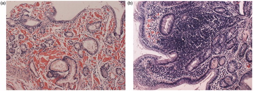 Figure 4. Results of gastrointestinal biopsy before and after IL-6 inhibitor therapy. (a) Massive amyloid A protein deposits were observed in the duodenal mucosa and submucosa before the start of tocilizumab therapy. (b) The marked regression of amyloid A protein deposits was observed in the duodenal mucosa and submucosa after the tocilizumab treatment (Congo red stained; 200× magnification) (quoted from Okuda et al. [Citation6]).