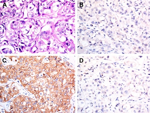 Figure 1 H&E staining (A), 100×, and immunohistochemistry (B) for TTF-1, (C) for CK7, (D) for Napsin A, 100×, of the specimen, which showed lung adenocarcinoma.