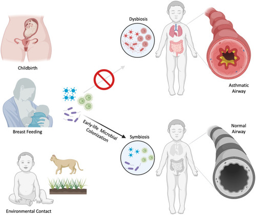 Figure 1 Early shaping of bronchial asthma by microbial exposure. Early-life microbial transfer occurs in utero and during childbirth (maternal intestinal and vaginal flora), during breast feeding (maternal milk microbiome) and contact with animals and soil (environmental microorganisms). These mechanisms allow colonization of commensals during early life. Failure to properly establish early symbiotic relationship with commensals results in dysbiosis and predisposes the host to allergic inflammation and bronchial asthma.