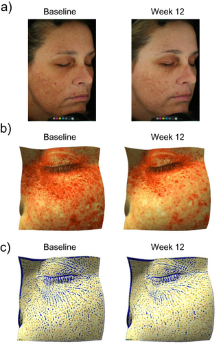Figure 4 Improvements observed in photodamaged skin after 12 weeks of DGR. Participant pictured was a 36-year-old woman with Fitzpatrick Skin Type III. (a) Photographs under cross-polarized lighting showing improvements in overall photodamage, fine lines, discoloration, and texture. (b) 3D images showing reductions in the appearance of dark spots and improvements in skin tone. (c) 3D images showing marked improvements in the appearance of fine lines/wrinkles.