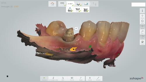 Figure 9 Final digital impression with Trios 3shape scanner.