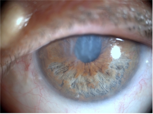 Figure 1 The anterior chamber is remarkably shallow and presents loose ends of degenerated anterior stromal leaf fibrils floating freely in the aqueous. The iris shows the typical features of iridoschisis, that is, stromal separation with cystic iris elevation in the inferior half and forward bowing of the iris (left eye).