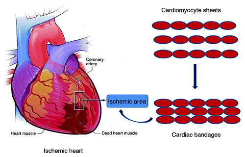 Figure 2. Schematic representation of use of cardiac bandages for treatment of ischemic heart (Reproduced with permission from ref. Citation21).