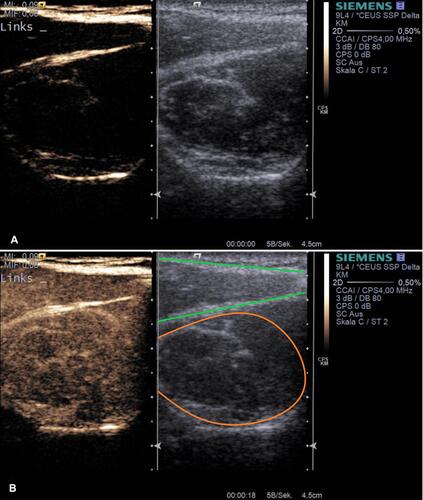 Figure 1 Example application of musculoskeletal CEUS. Dual modes with combined Cadence™ contrast mode and conventional B-mode ((A) before contrast agent application) are displayed after supraspinatus tendon tear (muscular area) inside the supraspinatus fossa (a+b). The lower image (B) represents the corresponding image after sulfur hexafluoride contrast agent application with maximum enhancement. Orange – supraspinatus muscle, green – trapezius muscle.