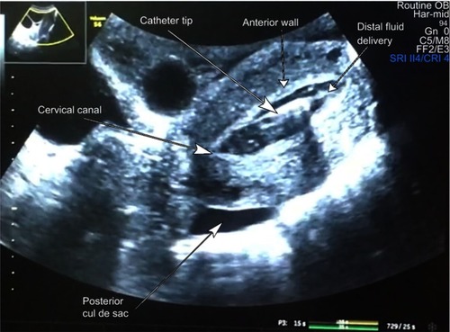 Figure 3 Optimal catheter position intra lavage.