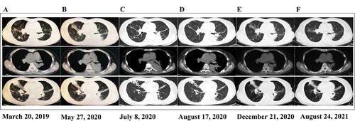 Figure 2. Imaging changes over time The upper section is the lung window, the middle section is the mediastinal window, and the lower section shows bronchiectasis lesions. A (March 20, 2019) shows the first chest CT obtained during the infection. Lesions were mainly observed in the upper lobe of the right lung, and bronchiectasis manifestation was observed, whereas in the lower lobe of the left lung, few significant lesions were seen. Subsequently, the patient was treated with trimethoprim-sulfamethoxazole (SMZ/TMP 400/80 mg; 0.96 g, po, q8 h) for 6 months. Her symptoms improved, and discontinuation of the medication was allowed. B (May 27, 2020) shows the first CT with recurrence of symptoms 1 year later—old lesions persisted in the right lung, and new-onset solid foci were observed in the left lung. She was then given SMZ/TMP (0.96 g, po, q8 h), meropenem (0.5 g, iv, q8 h) plus amikacin (0.4 g, iv, qd) and minocycline (100 mg, po, q12 h) plus SMZ/TMP (0.96 g, po, q8 h), but her symptoms were not completely resolved. C (July 8, 2020) shows the first chest CT scan obtained in our hospital, which showed no change compared with the last image. D (August 17, 2020) shows a chest CT scan after 24 days of linezolid (0.6 g, iv, q12 h) plus moxifloxacin (0.4 g, po, qd) treatment, which showed significant lesion absorption compared with the last image. E (December 21, 2020) shows a follow-up chest CT scan obtained after 4 months of linezolid (0.6 g, po, q12 h) plus moxifloxacin (0.4 g, po, qd) treatment and another 1 month of moxifloxacin monotherapy (0.4 g, qd, po), which resulted in complete absorption of the lesion. F (August 24, 2021) shows a follow-up chest CT scan obtained after drug withdrawal for more than 8 months, which showed no change compared with the last image. A, B, C, D, E and F indicate that precise antibiotic strategies were effective and necessary for treating the drug-resistant pathogen infection, and no exacerbation of bronchiectasis can be seen in these CT images.