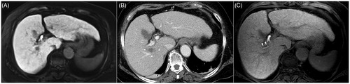 Figure 2. A 76-year-old woman with autoimmune hepatitis. (A) Hepatobiliary phase magnetic resonance image shows a 1-cm HCC (arrow) abutting the right bile duct in segment 7. The bile duct is visualized as a tubular structure with high-signal intensity (arrowheads) because of contrast excretion. The tumor is also close to the right main portal vein (anterior side) and right hepatic vein (posterior side). (B) Portal-phase CT scan obtained immediately after cryoablation show an oval-shaped ablation zone covering the entire tumor; the ablation zone size is small because a single cryoprobe was used. There is no bile duct dilatation, suggesting the absence of severe bile duct damage. In addition, the adjacent portal vein and hepatic vein seem to be patent, and there is no perfusion abnormality in the liver. (C) Hepatobiliary phase magnetic resonance image obtained 4 months after the procedure shows the intact right bile duct. There is no upstream bile duct dilatation (not shown). No local tumor progression was noted during the 29-month follow-up period.