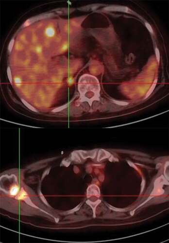 Figure 4. Representative images after the disease progresses. PET/CT indicated the new metastatic lesions of liver and bone.