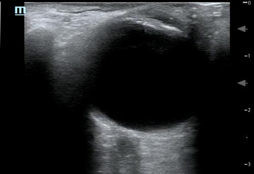 Figure 5 Normal ocular ultrasound with the lens visible at the superior aspect of the image and the optic nerve sheath visible at the inferior aspect of the image.