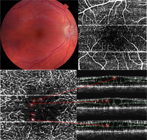 Figure 2 Observations in patient 2. Right eye: Perifoveal superficial vascular plexus in a 3 × 3 mm fovea-centered OCTA image with inferior interruption of the capillary network (upper right). Hyperreflective retinal abnormalities (ie, microvascular protrusions; red circles) within enlarged foveal avascular zone in the pDVP en face OCTA and B-scan images (lower band of images). Note the vascular retinal abnormality at the boundary between pSVP and pDVP on the upper B-scan image (red circle). Copyright © 2016 Karger Publishers, Basel, Switzerland. Adapted with permission from Stanga PE, Papayannis A, Tsamis E, et al. Swept-source optical coherence tomography angiography of paediatric macular diseases. Dev Ophthalmol. 2016;56:166–173.Citation25