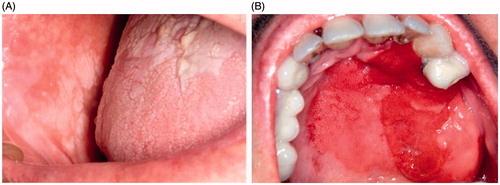 Figure 1. (A) Non-homogeneous leukoplakia in buccal mucosa and tongue. (B) Etrytroplasia in hard palate.