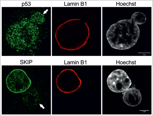 Figure 5. Nuclear co-activator SKIP is reduced in blebs. Primary p.S143F fibroblasts (p36 and p25, respectively) were stained for either SKIP or p53 and LB1. Hoechst was used to visualize DNA. Single mid-plane confocal sections from the whole cell are shown. SKIP is localized at the lamina in the main nuclear body but absent in the blebs (indicated with arrows) while p53 is equally distributed throughout the nucleoplasm. Scale bars 5 μm.
