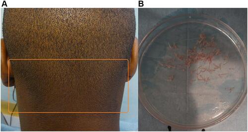 Figure 16 Photograph of the back of the head of patient 12 (African descent) showing short hair with directional synchrony in the nape area (A). The grafts are straight (B).