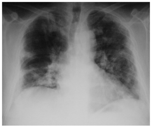 Figure 2 Chest X-ray, 2nd day.