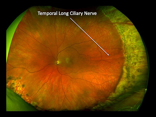 Figure 6 Coalescent, intense laser applications leave a large area of atrophic choroid and injures the temporal long ciliary nerve, risking internal ophthalmoplegia and denervation of the cornea.Citation23 Courtesy of Retina Specialists of Alabama, LLC.