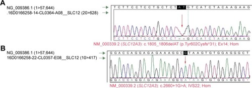 Figure 2 Sequencing chromatograms of the two detected mutations in the SLC12A3 gene are shown and confirmed by classical sequencing Sanger method. (A) NM_000339.2 (SLC12A3): c.1805_1806delAT (p.Tyr602Cysfs*31); EX14; Hom et (B) NM_000339.2 (SLC12A3): c.2660+1G>A; IVS22; Hom zygosity: Hom represents a homozygous mutation, Het represents a heterozygous mutation.