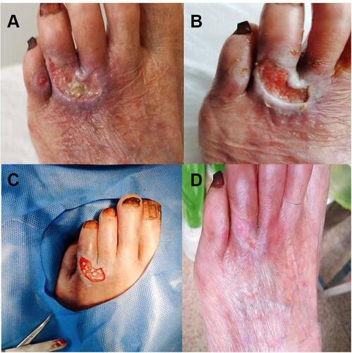 Figure 2 Typical case II. (A) Chronic wound on the back of forefoot for over six months. (B) Debridement and dressing change regularly. (C) Basically clean wound. (D) The wound is completely healed.