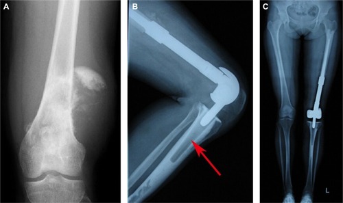 Figure 4 X-ray of patient with osteosarcoma of the left distal femur treated with all-polyethylene tibial endoprosthetic replacement.