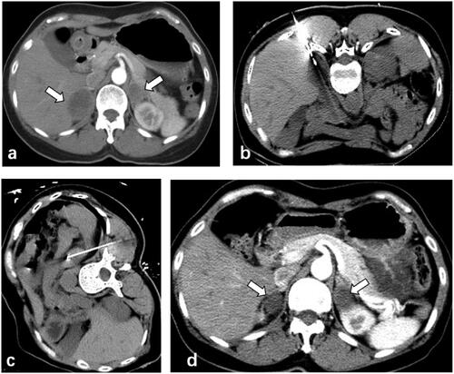 Figure 2. 56-year-old male patient with lung adenocarcinoma presented bilateral adrenal metastases after resection of the primary tumor (a) CT-guided microwave ablation was performed on the adrenal metastases in lateral position (b) and prone position (c) respectively. The adrenal metastases showed complete necrosis 6 months after ablation (d).