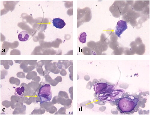 Figure 1. A large number of purple granular inclusions and needle-shaped crystals could be seen in the cytoplasm of bone marrow plasma cells (Wright Giemsa stain, 1000 × original magnification).