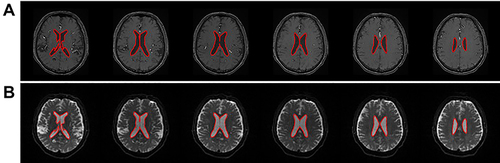 Figure 2 Example ROIs of the ventricle regions in (A) MRA images and the corresponding (B) magnitude images of MRE. The image slices including the ventricle regions were used for registration.