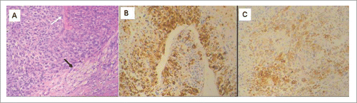 Figure 2. Pathological and immunohistochemistry features of pulmonary metastasis of uterine PEComa. (A) Tumor cells with prominent nucleoli and irregular mitoses were arranged radially around the blood vessels (white arrow), HE, × 100. Focal fat cells (black arrow) were found within tumor, HE × 100. (B, C) The tumor cells were positive for HMB45 (B), Melan-A (C) by immunohistochemistry staining, IHC × 100.