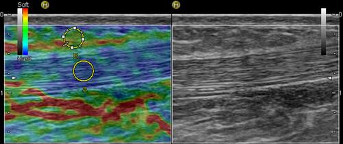 Figure 4 Sonoelastogram (left side of the images) of the lengthened region of the AT and corresponding B-mode ultrasound images (right side of the images) of the same area.