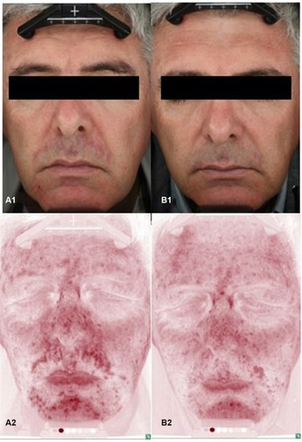 Figure 1 Standard and erythema-directed digital photography with VISIA-CR of a patient with moderate facial seborrheic dermatitis showing a significant reduction (P<0.001) in erythema after 15 days of treatment (erythema score: 2, B1–B2) compared to baseline (erythema score: 3, A1–A2).