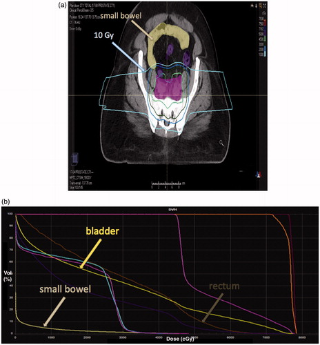 Figure 2. Significant small bowel sparing especially to doses less than 20 Gy in a prostate cancer patient treated to pelvic lymph nodes with proton beam therapy.