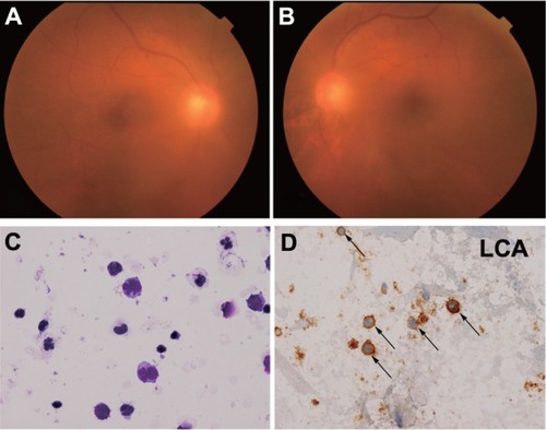 Figure 1 Fundus photographs and cytological examination of Case 1. Fundus photographs of (A) right and (B) left eye at the initial examination. Diffuse vitreous opacification can be seen in both eyes. (C) Atypical lymphocytes with anisonucleosis, aberrant chromatin, and dyskaryosis. Giemsa stain (400×). (D) Immunocytochemical findings (400×).