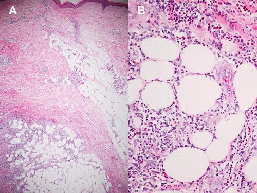 Figure 4 Histopathology of primary erythema nodosum; (A) Septal panniculitis with focal peripheral lobular infiltration (Hematoxylin-eosin stain, x40). (B) Higher magnification demonstrating numerous eosinophils in the area of focal peripheral lobular panniculitis (Hematoxylin-eosin stain, x400).