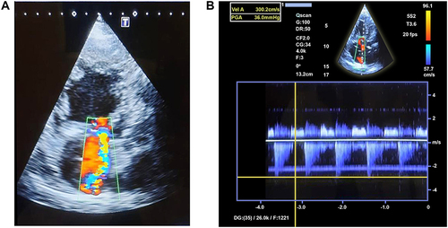 Figure 2 (A) Eccentric jet directed to the septal tricuspid leaflet. (B) TR velocity 3 cm/s and SPAP ≈45 mmHg.